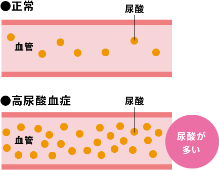 尿酸の血中濃度が非常に高い状態を言います。